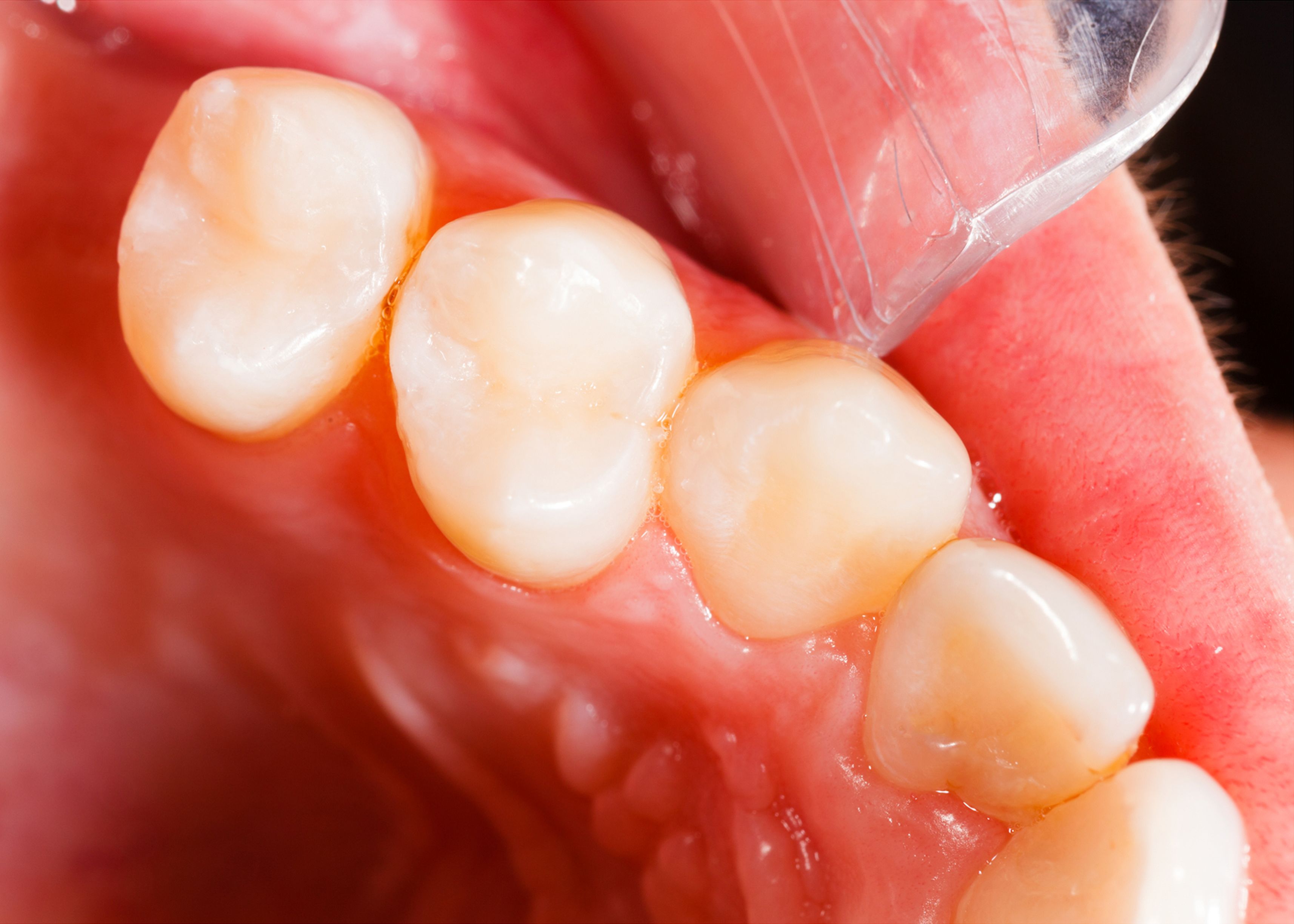 A tooth with a composite resin filling