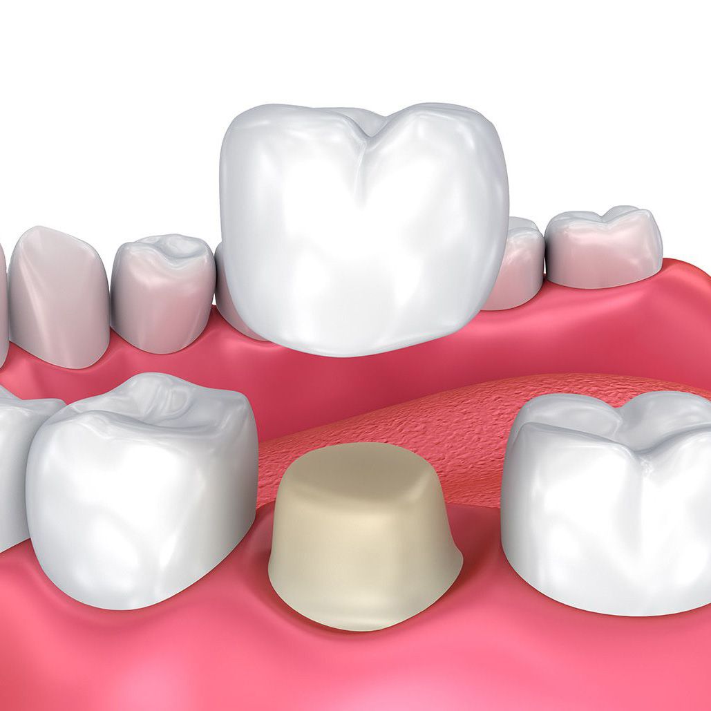 An illustration of a crown being placed on a tooth