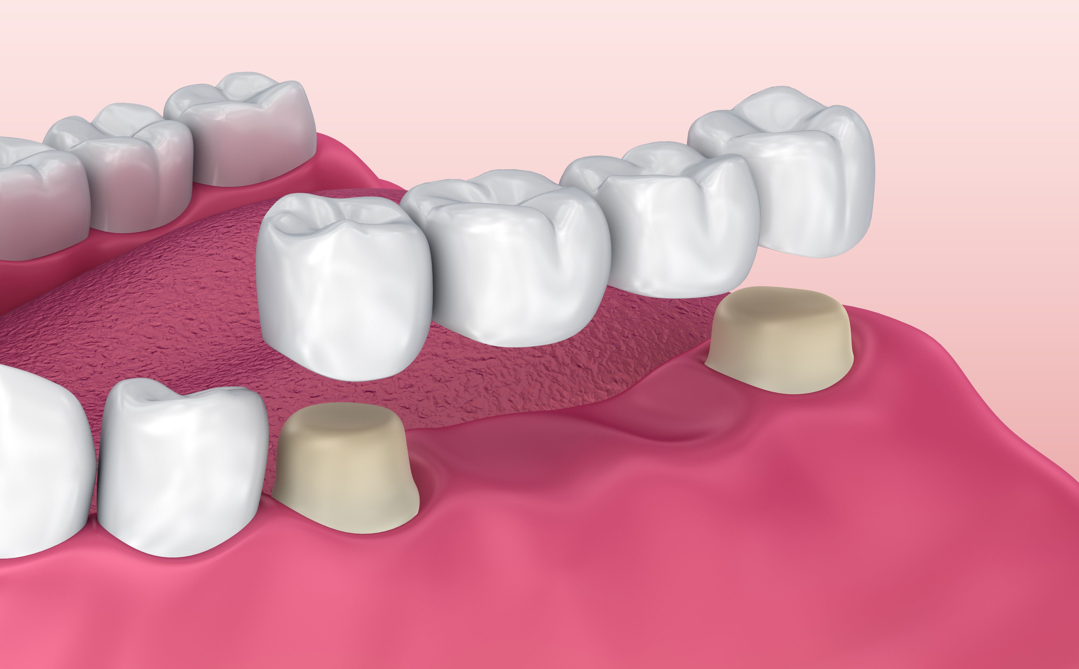 An illustration of a bridge being placed on a tooth