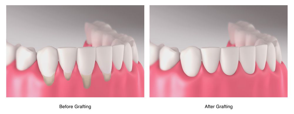 illustration of gum recession before and after gum grafting procedure